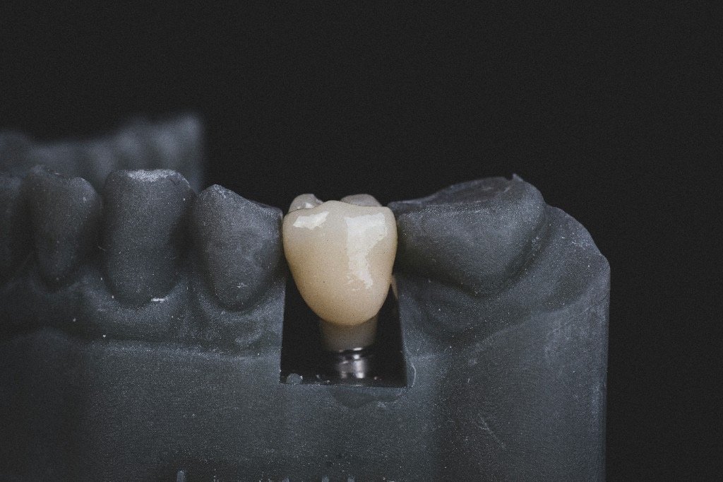 Kurore zirkoni në model dentar me abutment implant