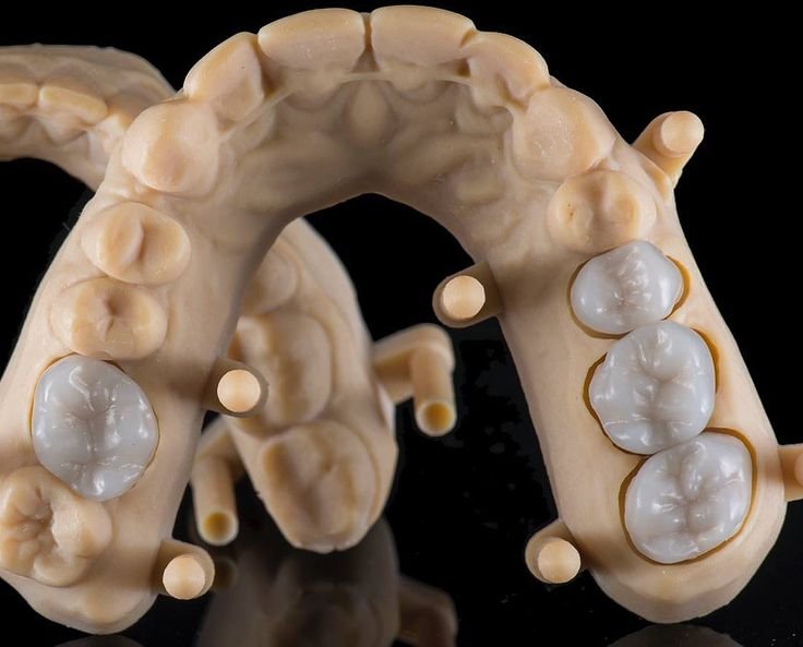 Model dentar i printuar në 3D me bazë resinë dhe kurora protetike