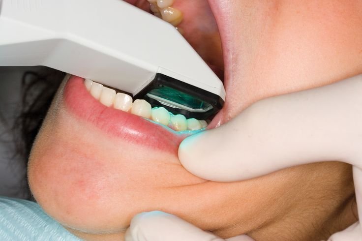 Skaner intraoral duke krijuar një impresion digjital të dhëmbëve të pacientit